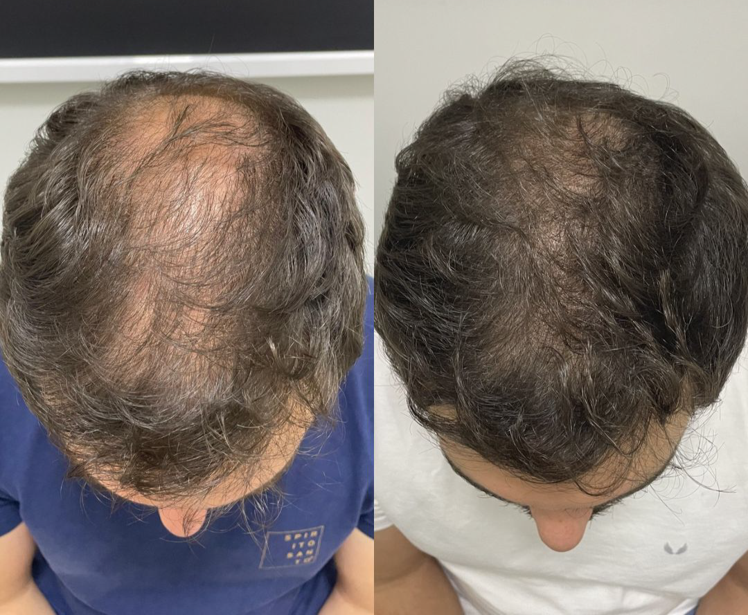 Dermatologia e Tricologia: por que a saúde do cabelo começa na pele do couro cabeludo
