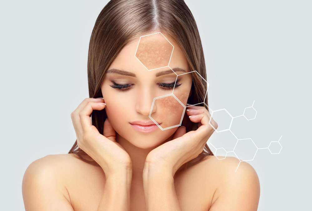 Melasma que não some: por que acontece e o que realmente funciona